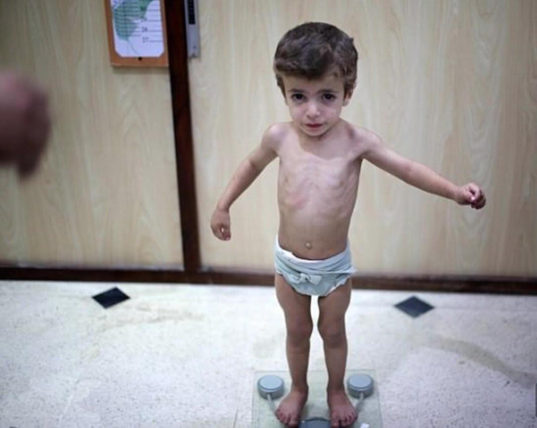  Kids are suffering from malnutrition in East Ghouta.