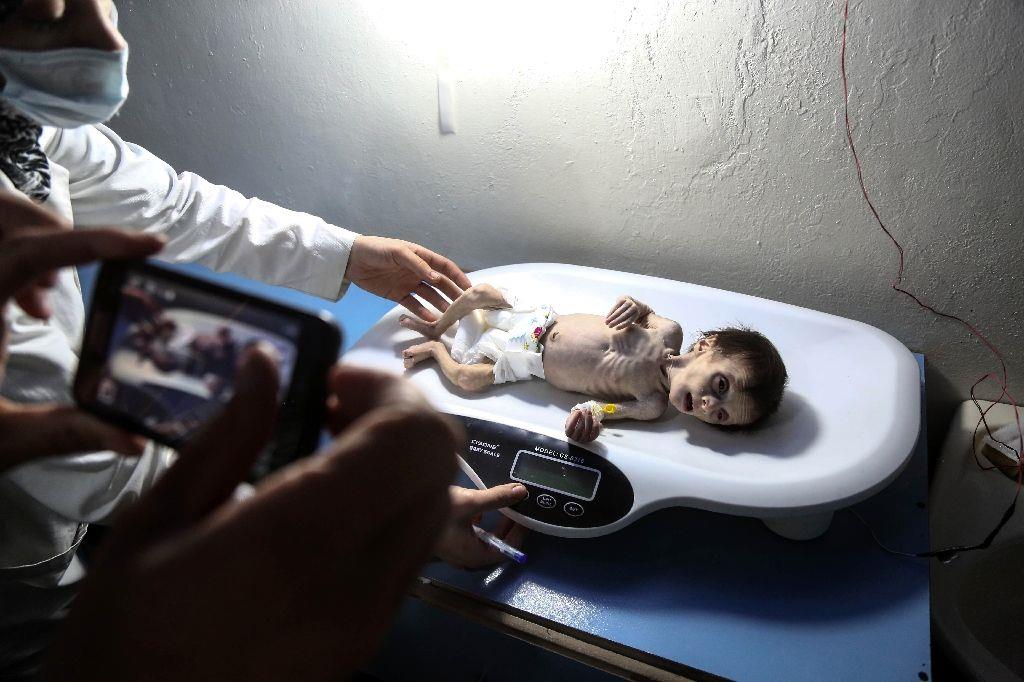 A Syrian child suffering from severe malnutrition is weighed at a clinic in the rebel-held town of Hamouria in the eastern Ghouta region near Damascus, on October 21, 2017