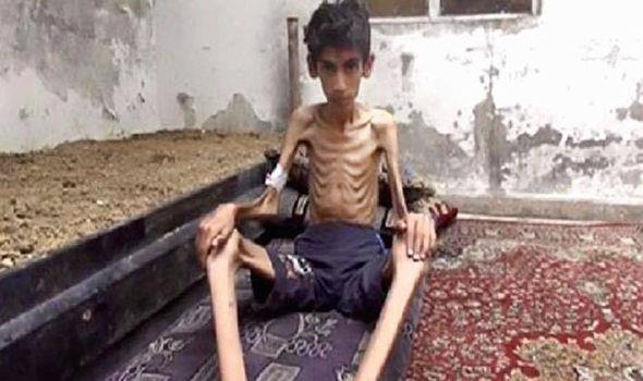 File Photo, A starving boy in Madaya, Syria