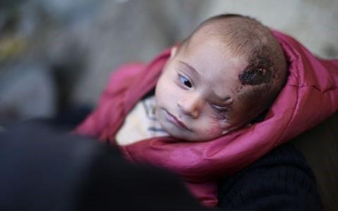 Three-month-old Kareem lost his left eye and his mother after an Assad regime attack on Eastern Ghouta
