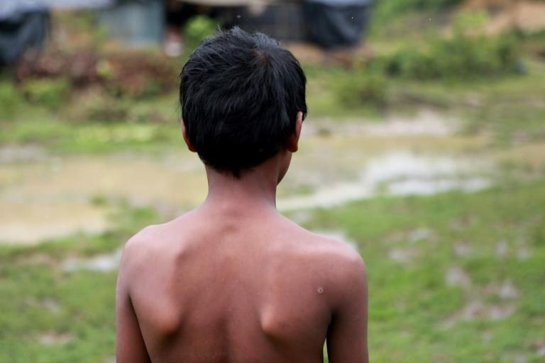 Jamal Hussain, a 12-year-old Rohingya refugee, bears an exit wound where a piece of shrapnel struck him as he fled an outbreak of violence 