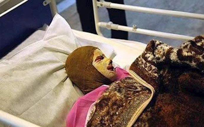 Another Piranshahr schoolgirl dies of severe burns