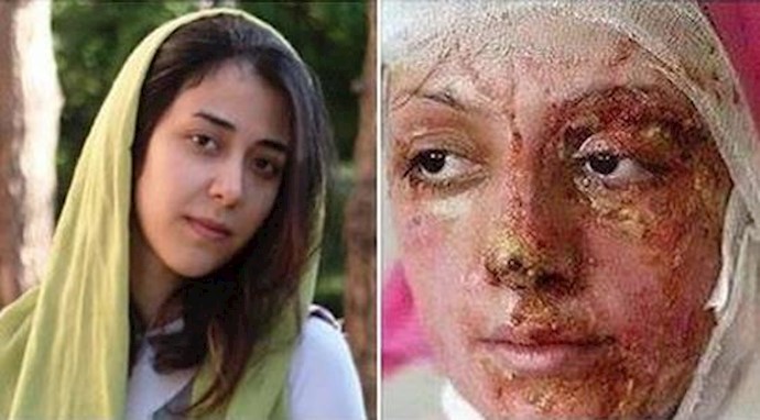  'A victim of barbaric acid attack in Iran'