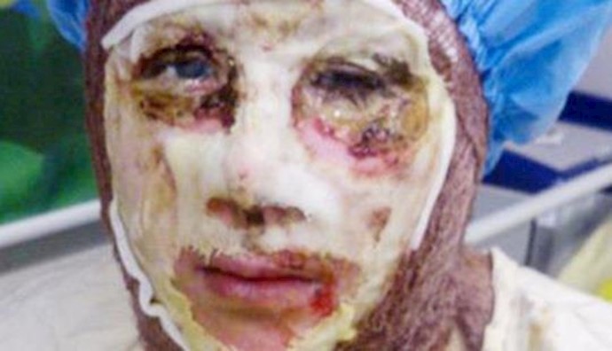  'Another victim of acid attack in Isfahan'