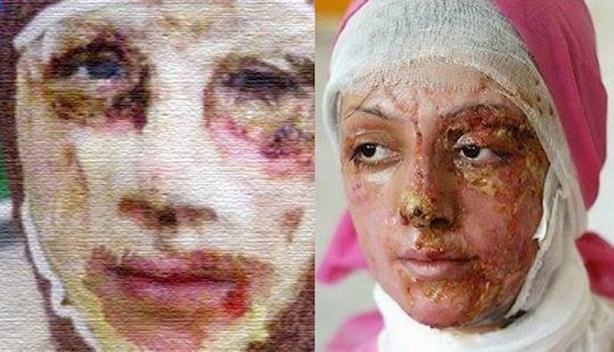 New York Times: Acid attack in Iran after a new law passed in the parliament
