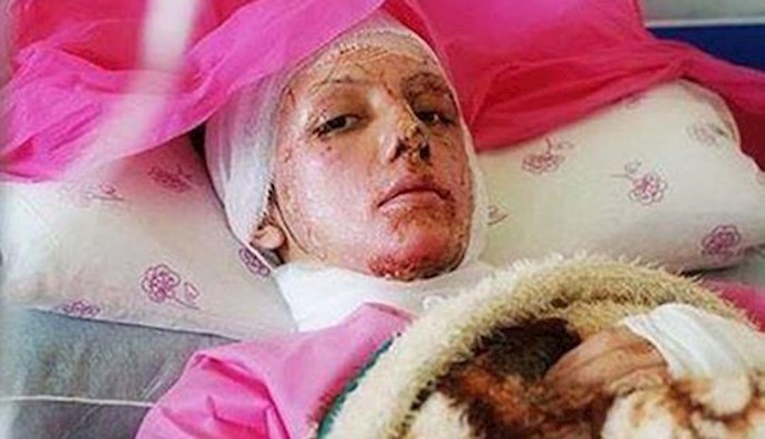  'One victim of acid attack in city of Isfahan'