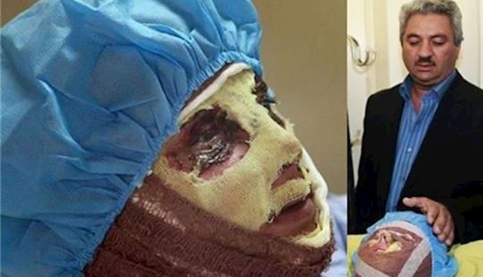  'Acid attack victim threatened not to go public'