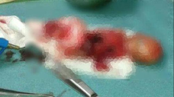Woman loses unborn baby in Aleppo bombing