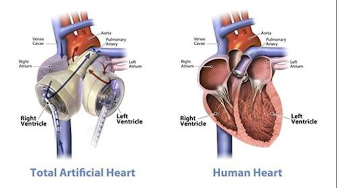  'A side-by-side comparison of a human heart and the Total Artificial Heart'