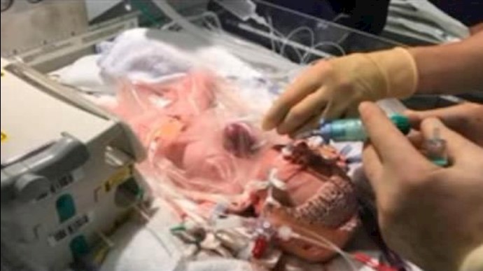 Baby’s heart placed back inside her chest in rare surgeries