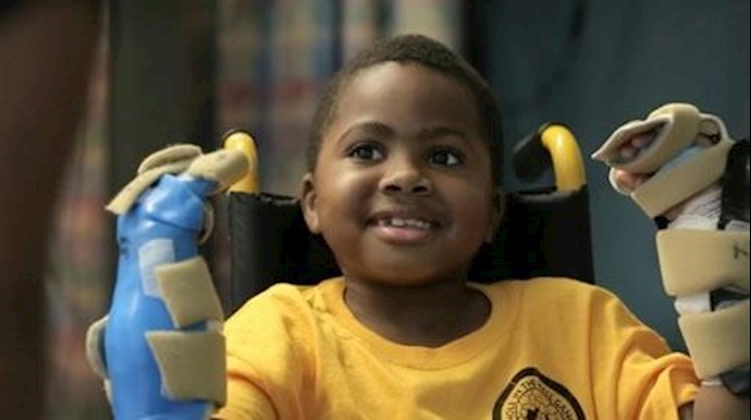 World’s first child hand transplant a ‘success’
